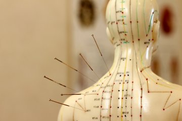 Chinesische Akupunktur